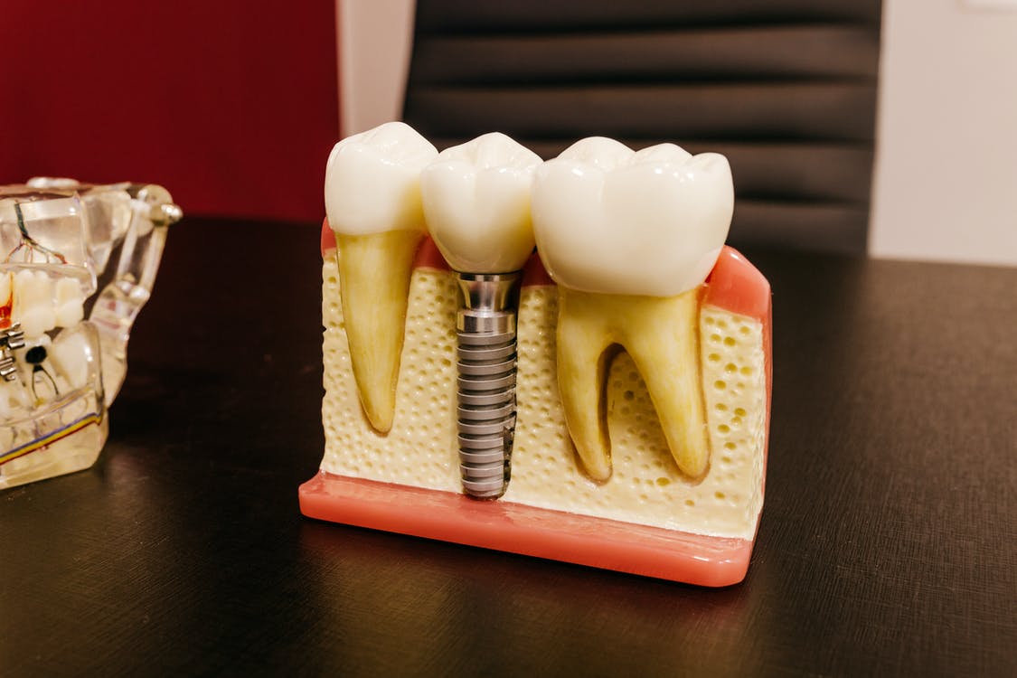 Why are Dental Implants Necessary?